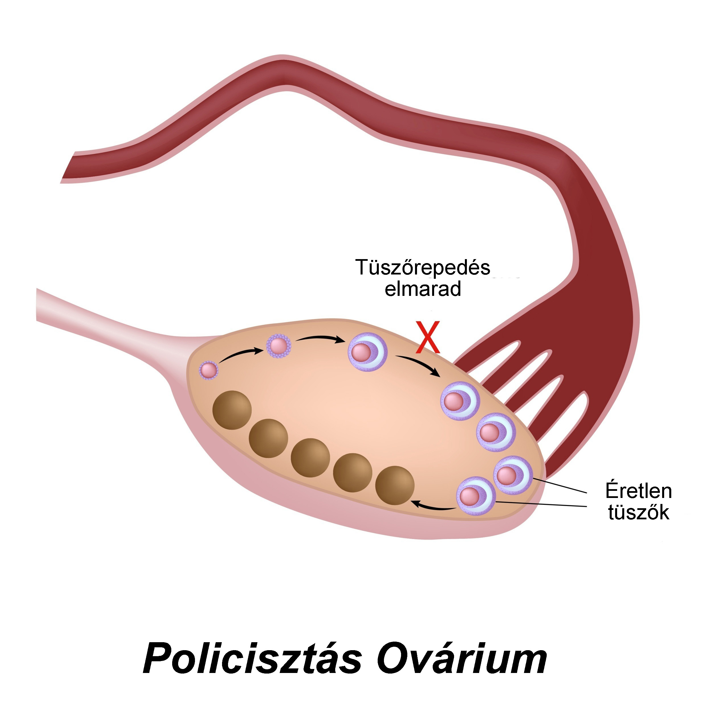 fogyás ovuláció pcos súlyok jóak a zsírégetéshez
